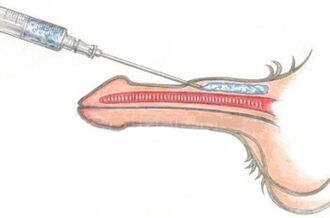 O metodă periculoasă de mărire a penisului folosind injecții cu vaselină